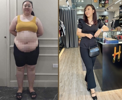 Tỷ lệ thành công của phẫu thuật nội soi thu nhỏ dạ dày như thế nào?